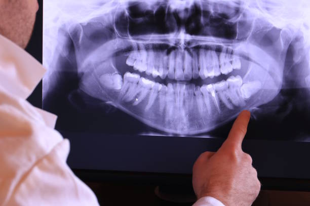 Best Emergency Wisdom Tooth Extraction in Santa Ynez, CA